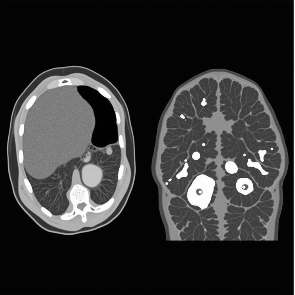 CT scan tuyến cận giáp: So sánh giữa U nang và Tăng sản