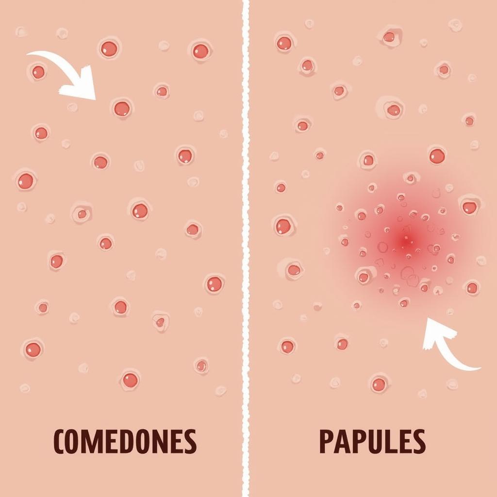 So sánh Comedones và Papules