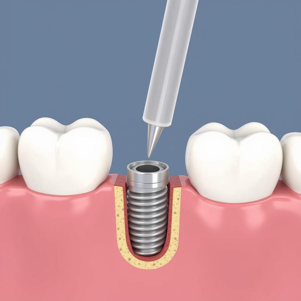 Cấy ghép implant titanium: Hình ảnh minh họa quy trình cấy ghép implant titanium, cho thấy sự tích hợp xương và cấu trúc của implant.